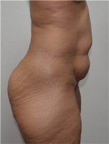 Liposuction Before Photo by Jon Ver Halen, MD; Southlake, TX - Case 33717