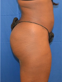 Liposuction After Photo by Jon Ver Halen, MD; Southlake, TX - Case 33945