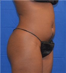 Liposuction Before Photo by Jon Ver Halen, MD; Southlake, TX - Case 33945