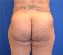 Buttock Lift with Augmentation After Photo by Jon Ver Halen, MD; Southlake, TX - Case 33996