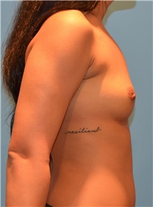 Breast Augmentation Before Photo by Jon Ver Halen, MD; Southlake, TX - Case 34197