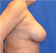 Breast Augmentation After Photo by Jon Ver Halen, MD; Southlake, TX - Case 35238
