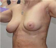 Breast Augmentation Before Photo by Jon Ver Halen, MD; Southlake, TX - Case 35238