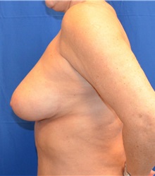 Breast Augmentation After Photo by Jon Ver Halen, MD; Southlake, TX - Case 35238