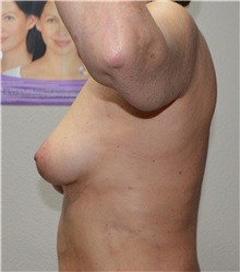 Breast Augmentation Before Photo by Jon Ver Halen, MD; Southlake, TX - Case 35238