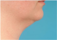 Liposuction Before Photo by Jon Ver Halen, MD; Southlake, TX - Case 35346