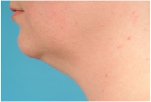 Liposuction Before Photo by Jon Ver Halen, MD; Southlake, TX - Case 35346