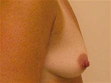 Breast Augmentation Before Photo by Brooke Seckel, MD; Concord, MA - Case 27435