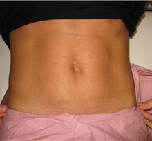 Tummy Tuck After Photo by Brooke Seckel, MD; Concord, MA - Case 27437