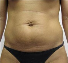 Tummy Tuck Before Photo by Brooke Seckel, MD; Concord, MA - Case 27437
