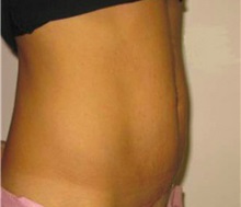 Tummy Tuck After Photo by Brooke Seckel, MD; Concord, MA - Case 27437