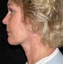 Facelift After Photo by Brooke Seckel, MD; Concord, MA - Case 27474