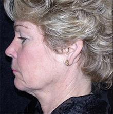 Facelift Before Photo by Brooke Seckel, MD; Concord, MA - Case 27474