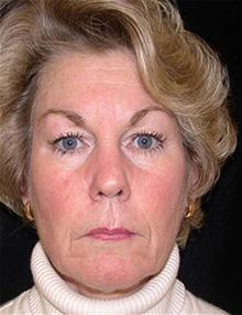 Facelift Before Photo by Brooke Seckel, MD; Concord, MA - Case 27474