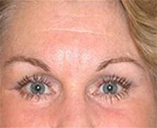 Eyelid Surgery After Photo by Brooke Seckel, MD; Concord, MA - Case 27477