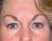 Eyelid Surgery Before Photo by Brooke Seckel, MD; Concord, MA - Case 27477