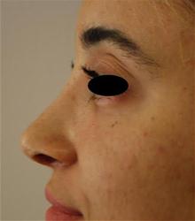Rhinoplasty After Photo by Brooke Seckel, MD; Concord, MA - Case 27479