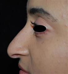 Rhinoplasty Before Photo by Brooke Seckel, MD; Concord, MA - Case 27479