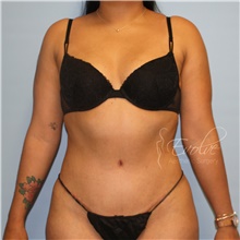 Tummy Tuck After Photo by Jason Hess, MD; San Diego, CA - Case 47067