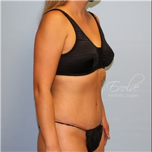 Tummy Tuck After Photo by Jason Hess, MD; San Diego, CA - Case 47068