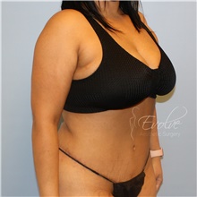 Tummy Tuck After Photo by Jason Hess, MD; San Diego, CA - Case 47070