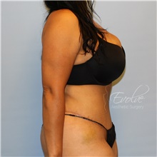 Tummy Tuck After Photo by Jason Hess, MD; San Diego, CA - Case 47070