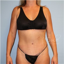 Tummy Tuck After Photo by Jason Hess, MD; San Diego, CA - Case 47073