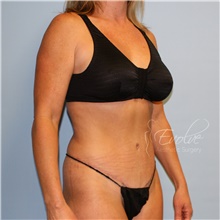 Tummy Tuck After Photo by Jason Hess, MD; San Diego, CA - Case 47073