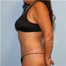 Tummy Tuck After Photo by Jason Hess, MD; San Diego, CA - Case 47074