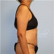 Tummy Tuck After Photo by Jason Hess, MD; San Diego, CA - Case 47077