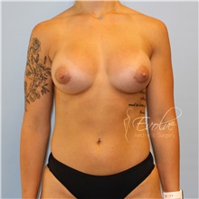 Breast Augmentation After Photo by Jason Hess, MD; San Diego, CA - Case 47079