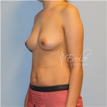 Breast Augmentation Before Photo by Jason Hess, MD; San Diego, CA - Case 47080