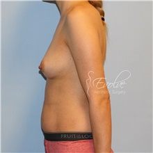 Breast Augmentation Before Photo by Jason Hess, MD; San Diego, CA - Case 47080
