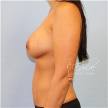 Breast Augmentation After Photo by Jason Hess, MD; San Diego, CA - Case 47082