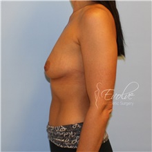 Breast Augmentation Before Photo by Jason Hess, MD; San Diego, CA - Case 47082