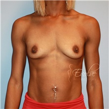 Breast Augmentation Before Photo by Jason Hess, MD; San Diego, CA - Case 47084
