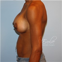 Breast Augmentation After Photo by Jason Hess, MD; San Diego, CA - Case 47084