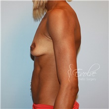 Breast Augmentation Before Photo by Jason Hess, MD; San Diego, CA - Case 47084