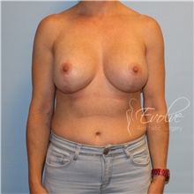 Breast Augmentation After Photo by Jason Hess, MD; San Diego, CA - Case 47175