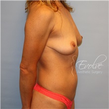 Breast Augmentation Before Photo by Jason Hess, MD; San Diego, CA - Case 47175