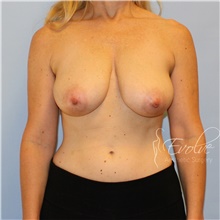 Breast Reduction Before Photo by Jason Hess, MD; San Diego, CA - Case 47243