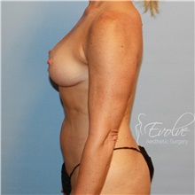 Breast Reduction After Photo by Jason Hess, MD; San Diego, CA - Case 47243