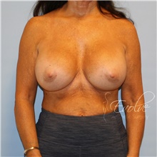 Breast Implant Revision After Photo by Jason Hess, MD; San Diego, CA - Case 47247