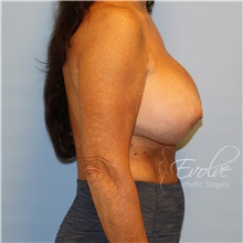 Breast Implant Revision After Photo by Jason Hess, MD; San Diego, CA - Case 47247