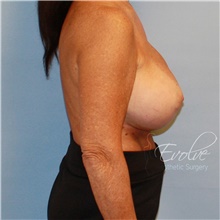 Breast Implant Revision Before Photo by Jason Hess, MD; San Diego, CA - Case 47247