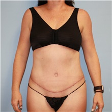 Tummy Tuck After Photo by Jason Hess, MD; San Diego, CA - Case 47937