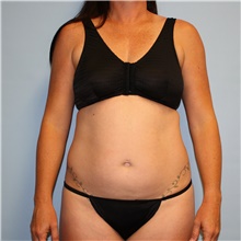 Tummy Tuck Before and After Photos  American Society of Plastic Surgeons
