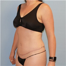 Tummy Tuck After Photo by Jason Hess, MD; San Diego, CA - Case 47937