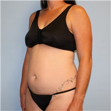 Tummy Tuck Before Photo by Jason Hess, MD; San Diego, CA - Case 47937