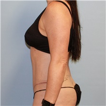 Tummy Tuck After Photo by Jason Hess, MD; San Diego, CA - Case 47937